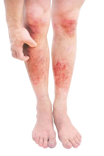 异位性皮炎 Atopic Dermatitis 简称Ad 又称特发性湿疹 Atopic Eczema 是一种皮肤炎症 — 图库照片