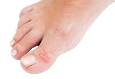 Genç bir kızın bacağında nasır var. ciltte sorunlu alanlar ile kadın ayak, kuru nasır.