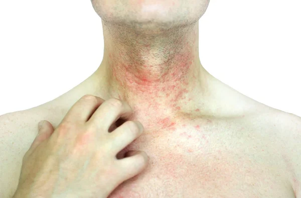 アトピー性皮膚炎 アトピー性皮膚炎とも呼ばれ 皮膚炎 皮膚炎 の一種です — ストック写真