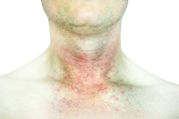 异位性皮炎 Atopic Dermatitis 简称Ad 又称特发性湿疹 Atopic Eczema 是一种皮肤炎症 — 图库照片