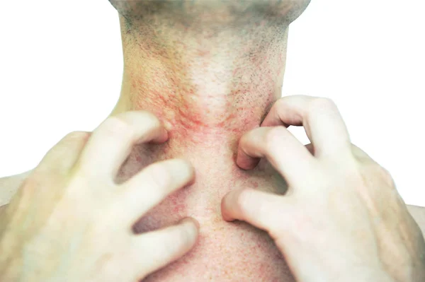 Atopische Dermatitis Ook Bekend Als Atopisch Eczeem Een Type Huidontsteking — Stockfoto