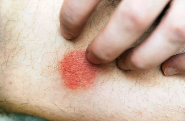 Atopisk Dermatit Även Känd Som Atopiskt Eksem Typ Inflammation Huden — Stockfoto