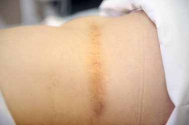 A scar of appendicitis on the abdomen of a woman clipart