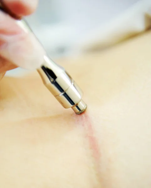 Laser removal of scars and scars on the abdomen of a woman