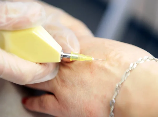 Tratamiento Con Dióxido Carbono Carboxiterapia Rejuvenecimiento Piel — Foto de Stock