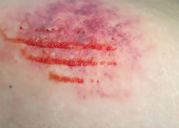 Hematom, yumuşak doku yaralanması