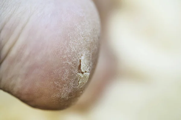 Foot care, cracked skin on heels, close-up — Stock Photo, Image