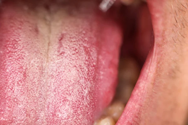 medicine, what the tongue says, white bloom on the tongue close-up