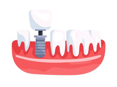 Bir sıra diş ve diş implantı olan çene kısmının modeli. Bir taç takmak. Düz vektör clipart, izole edilmiş arkaplan ile illüstrasyon.
