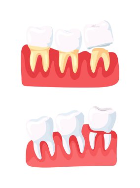 Dişleri olan insan çenesi modeli. Dişlerle ilgili sorun. Düz vektör clipart, izole edilmiş arkaplan ile illüstrasyon.