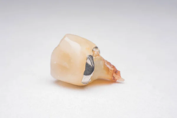 Зубы Зуб Кариес Гнилой Зуб — стоковое фото