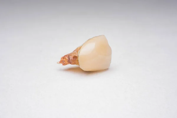 Dentes Dente Cárie Dente Cariado — Fotografia de Stock