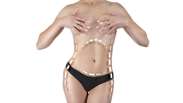 Het lichaam van de vrouw met merken op de maag. Plastische chirurgie afslanken en dieet concept. — Stockfoto