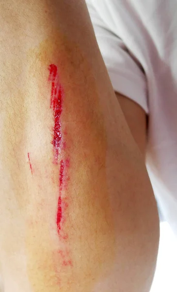 Gli uomini hanno ferite sulla pelle intorno alle braccia — Foto Stock