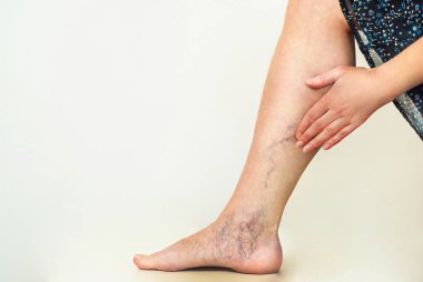 Varicose veins on the womans legs clipart