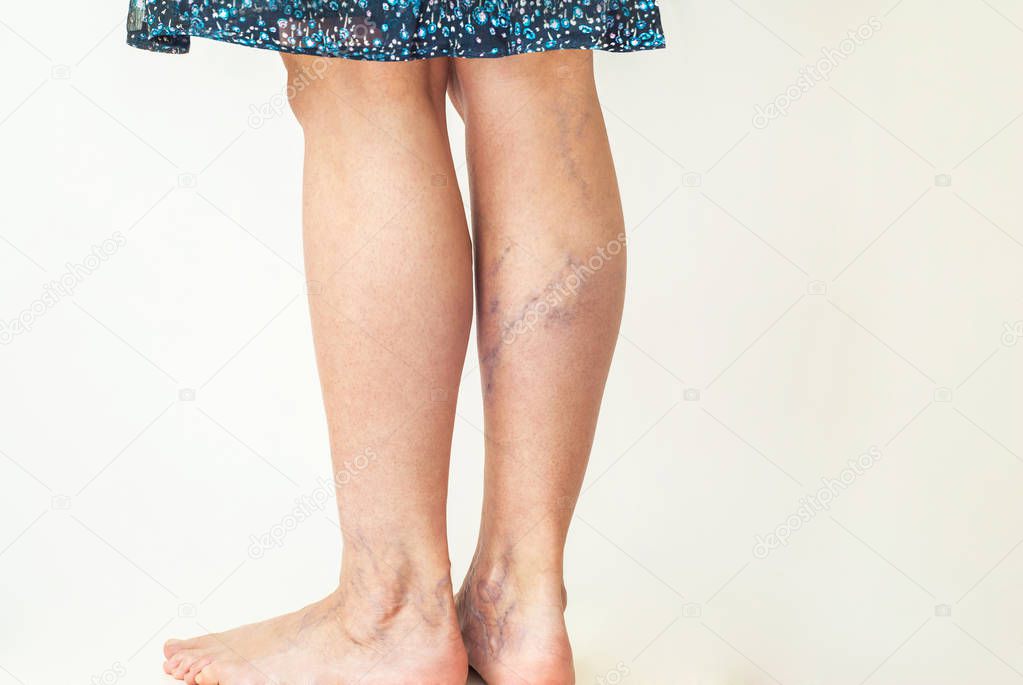 Varicose veins on the womans legs