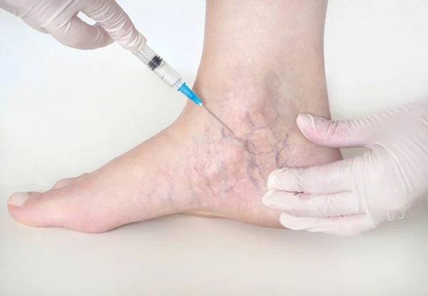 Spider veins on the womans legs, sclerotherapy treatment