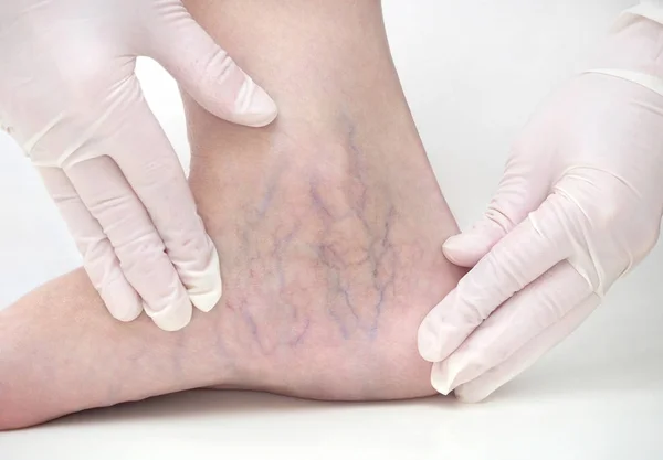 Spider veins on the womans legs, sclerotherapy treatment