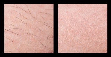 Epilasyon ve sugaring. Epilasyon. folikül. Şeker ya da balmumu ile kadın bacak. Önce ve sonra. Süreci ve Depilasyon adımlardan. Kozmetik, welness ve güzellik