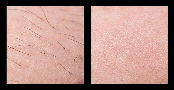 Depilación y azúcar. Depilación. folículo. Pierna de mujer con azúcar o cera. Antes y después. Proceso y pasos de depilación. cosmetología, cuidado corporal y belleza — Foto de Stock