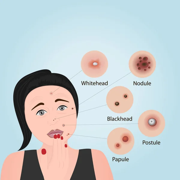 Tipos de acne em uma ilustração de vetor de face. Cosmetologia —  Vetores de Stock