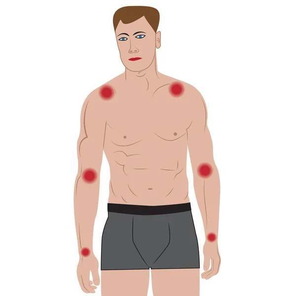 Dolor articular en los brazos por infección o lesión del cuerpo masculino — Vector de stock