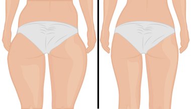 Fat thigs correction.  Liposuction. Before and after. Woman body correction vector illustration clipart