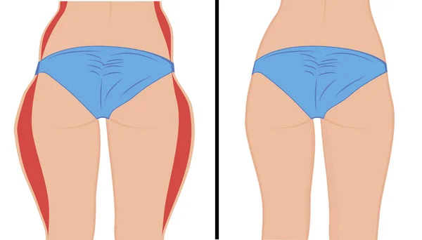 Corrección de pelucas de grasa. Liposucción. Antes y después. Mujer cuerpo corrección vector ilustración — Vector de stock