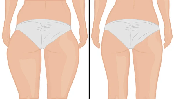 Fat thigs correction.  Liposuction. Before and after. Woman body correction vector illustration — Stock Vector