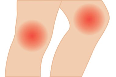 Diz eklem ağrısı vektör çizim. hyperextension tedavi 