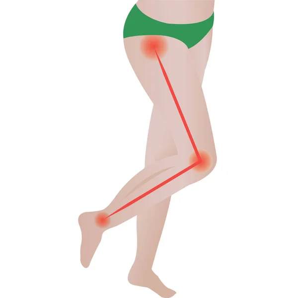 Боли в суставах Ятанический нерв. седалищная боль в спине. векторная иллюстрация — стоковый вектор