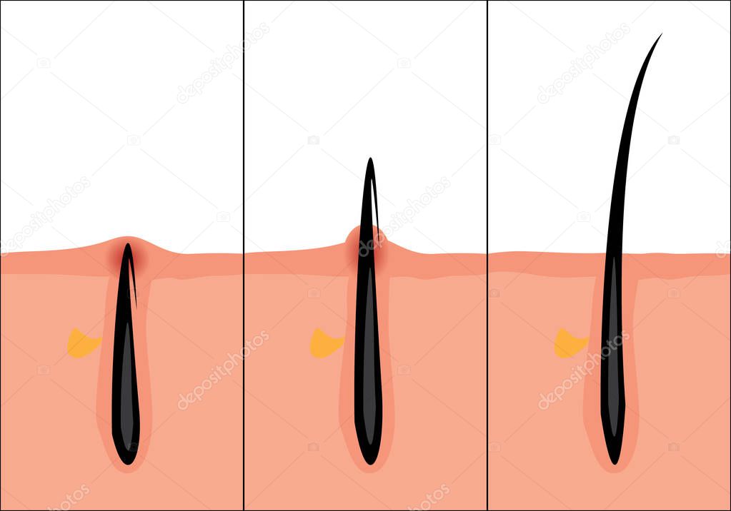 Normal and ingrown hair vector illustration