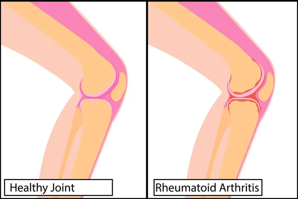 Ilustração médica saudável do vetor da articulação do joelho e da artrite reumatoide — Vetor de Stock