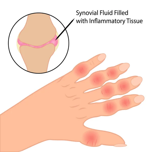 Reumatoïde artritis op vingers medische vectorillustratie — Stockvector
