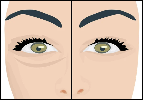 Cercles noirs sous les yeux à enlever avant et après — Image vectorielle