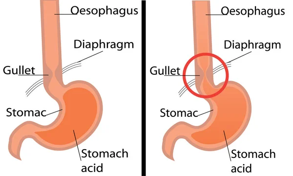 Diagrama da doença do refluxo gastroesofágico. Ilustração do vetor de estômago saudável e gérmen — Vetor de Stock