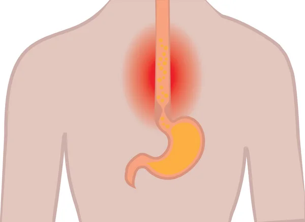 Malattia da reflusso gastroesofageo. Bruciore di stomaco Gerd stomaco in un corpo umano vettoriale illustrazione — Vettoriale Stock