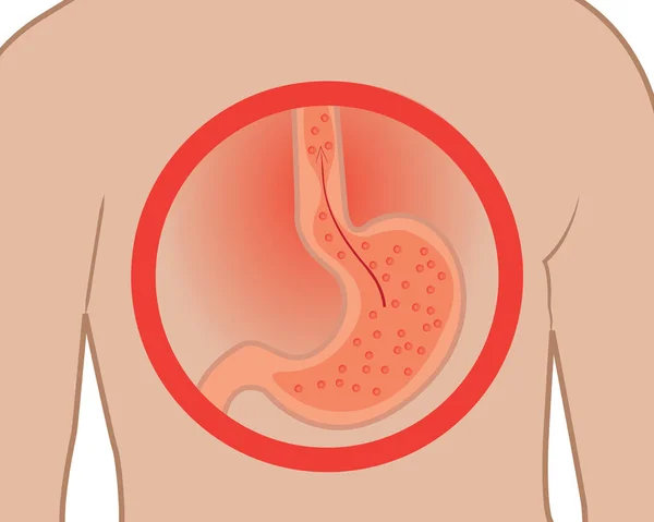 Doença de refluxo gastroesofágico. Heartburn Gérd estômago em um corpo humano ilustração vetorial — Vetor de Stock