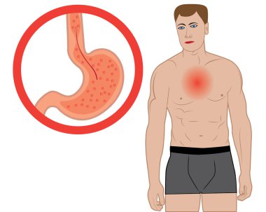 Gastroesophageal reflux disease. Gerd stomach in a human body vector illustration clipart