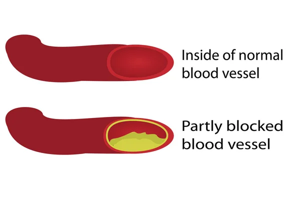 Ilustración de vasos sanguíneos sanos y bloqueados — Vector de stock