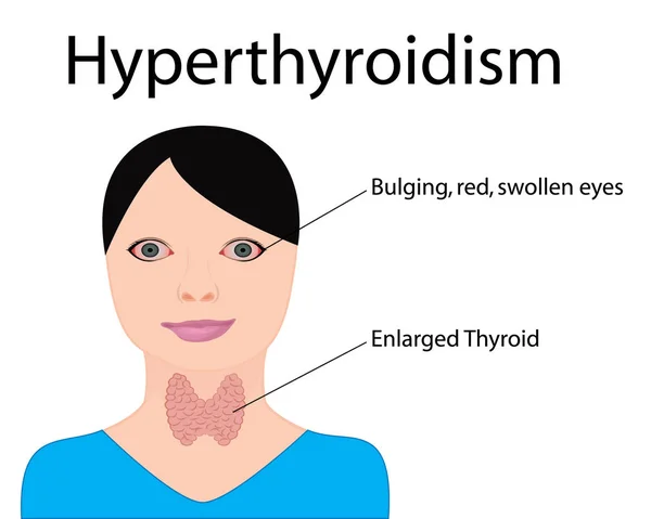 Hipertiroidi. Büyümüş tiroid. Endokrin disfonksiyonu vektör — Stok Vektör