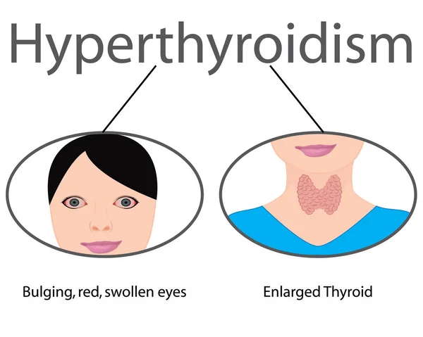 Hipertiroidismo. Tiroides agrandada. Ilustración vectorial de disfunción endocrina — Archivo Imágenes Vectoriales