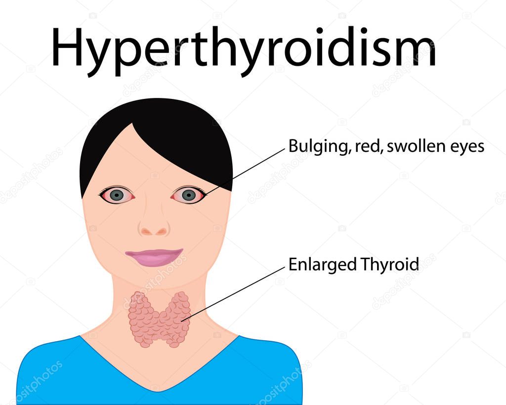  Hyperthyroidism.  Enlarged Thyroid. Endocrine disfunction vector