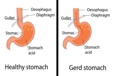 Gastroözofageal reflü desease. Mide ve sağlıklı mide vektör çizim