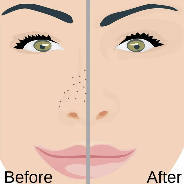 Las espinillas se quitan en el tratamiento de nariz antes y después. El poro reduce los problemas de piel — Vector de stock