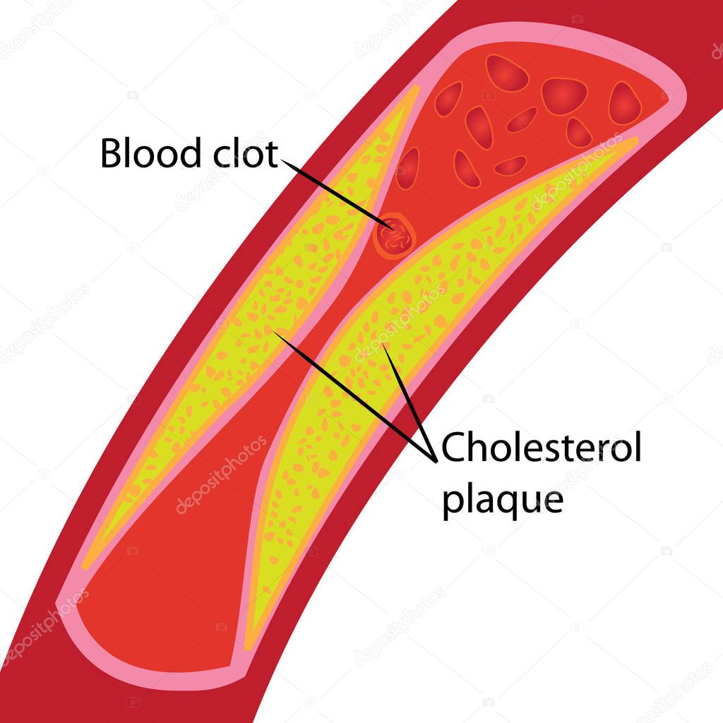 Blood clot and cholesterol plaque. Blocked blood vessel illustration