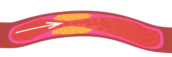 Cholesterinspiegel in Gefäßen — Stockvektor