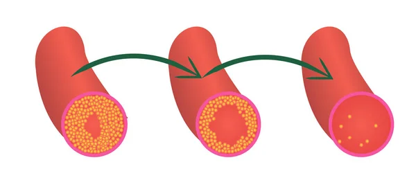 혈관 플 라크 콜레스테롤의 수준을 줄이기 위해 — 스톡 벡터