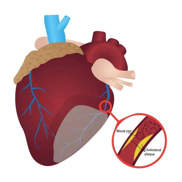 Plaque de cholestérol caillot sanguin i Crise cardiaque — Image vectorielle