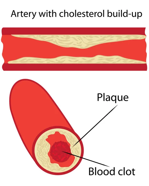 Cholesterol plaque in artery — Stock Vector